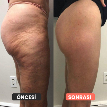 Thermoslim Vücut Şekillendirici