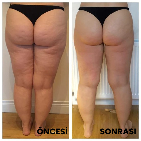 Thermoslim Vücut Şekillendirici